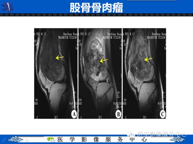 【病例学习】腓骨骨肉瘤一例影像诊断与鉴别