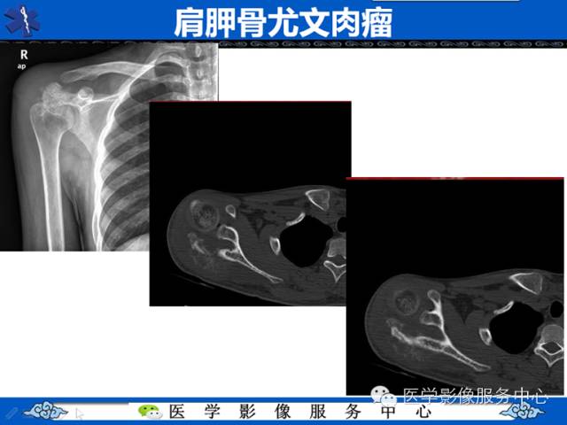 【病例学习】腓骨骨肉瘤一例影像诊断与鉴别