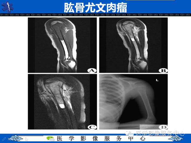 【病例学习】腓骨骨肉瘤一例影像诊断与鉴别