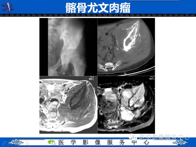【病例学习】腓骨骨肉瘤一例影像诊断与鉴别
