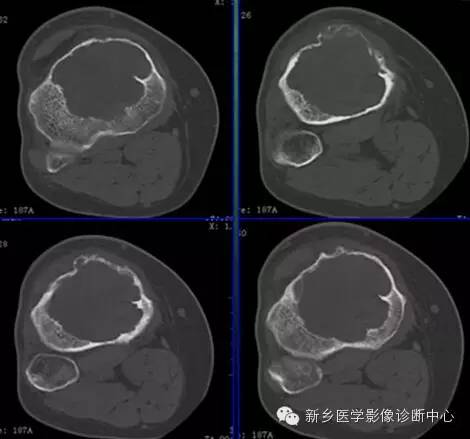 【一句话学影像】之四不像的骨母细胞瘤
