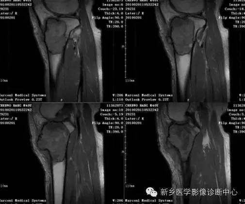 【一句话学影像】之四不像的骨母细胞瘤 【一句话学影像】之四不像的骨母细胞瘤