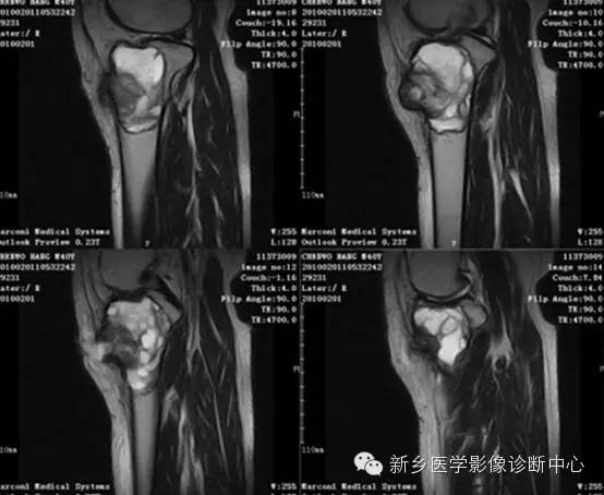 【一句话学影像】之四不像的骨母细胞瘤 【一句话学影像】之四不像的骨母细胞瘤
