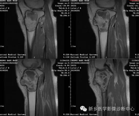 【一句话学影像】之四不像的骨母细胞瘤 【一句话学影像】之四不像的骨母细胞瘤