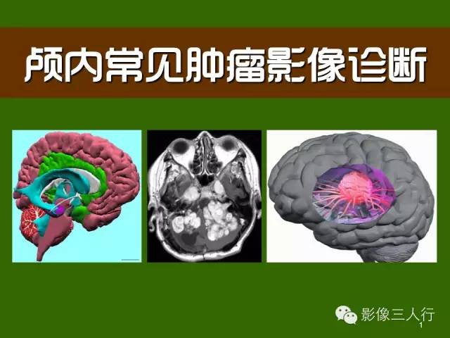 颅内常见肿瘤影像诊断