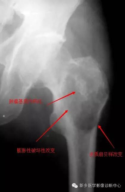 【一句话学影像】难啃的骨头——软骨肉瘤