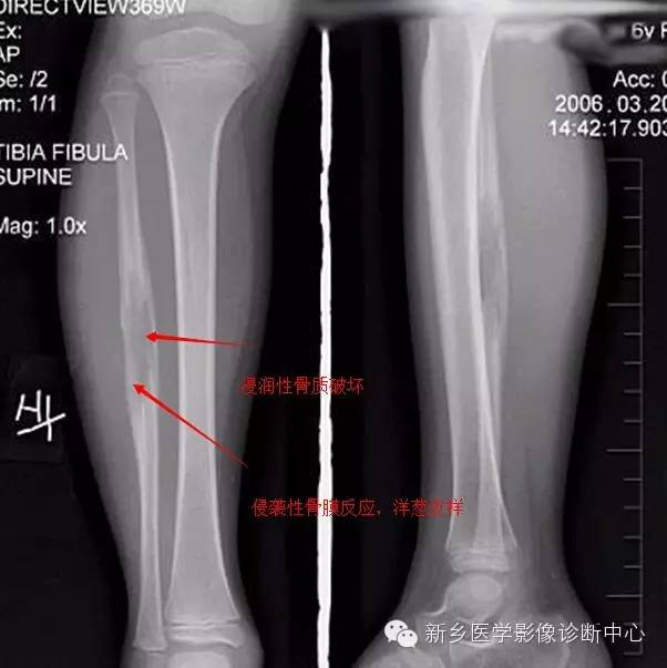 【一句话学影像】难啃的骨头——尤文氏肉瘤