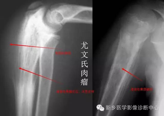 【一句话学影像】难啃的骨头——尤文氏肉瘤 【一句话学影像】难啃的骨头——尤文氏肉瘤