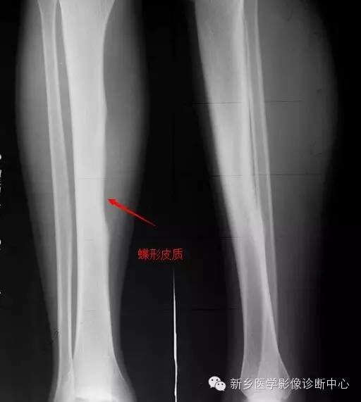【一句话学影像】难啃的骨头——尤文氏肉瘤 【一句话学影像】难啃的骨头——尤文氏肉瘤