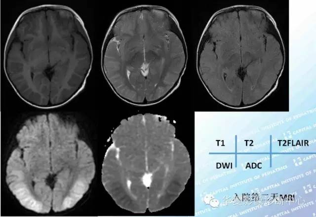 【病例学习】低血糖脑病一例MR影像表现