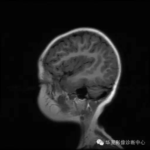 【病例学习】Dandy- Walker's畸形一例MR影像表现