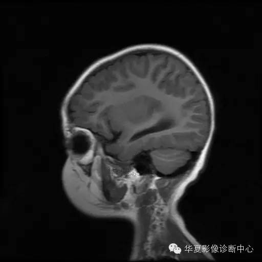 【病例学习】Dandy- Walker's畸形一例MR影像表现 【病例学习】Dandy- Walker's畸形一例MR影像表现