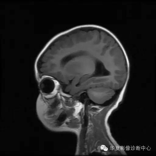 【病例学习】Dandy- Walker's畸形一例MR影像表现 【病例学习】Dandy- Walker's畸形一例MR影像表现