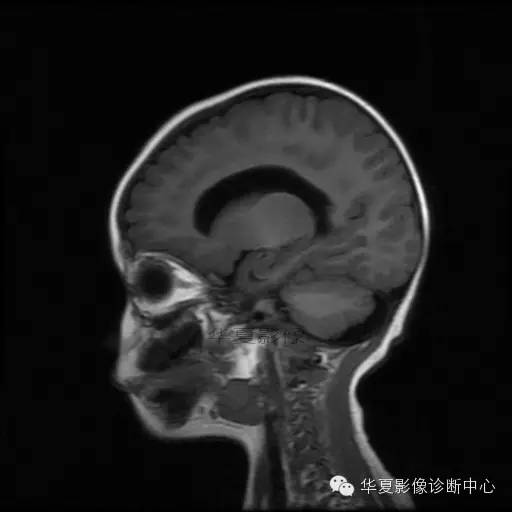 【病例学习】Dandy- Walker's畸形一例MR影像表现 【病例学习】Dandy- Walker's畸形一例MR影像表现