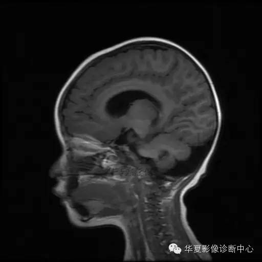 【病例学习】Dandy- Walker's畸形一例MR影像表现 【病例学习】Dandy- Walker's畸形一例MR影像表现