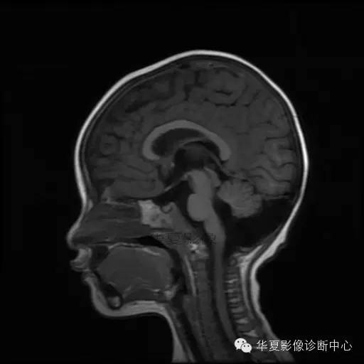 【病例学习】Dandy- Walker's畸形一例MR影像表现 【病例学习】Dandy- Walker's畸形一例MR影像表现