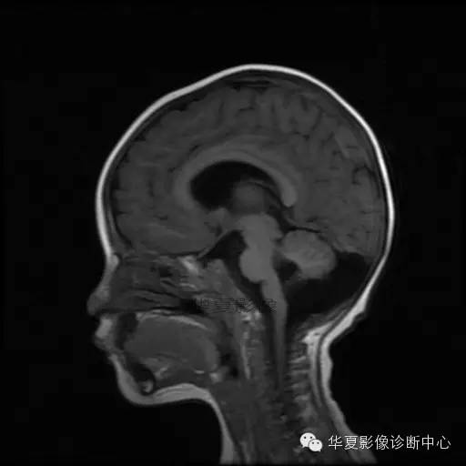 【病例学习】Dandy- Walker's畸形一例MR影像表现 【病例学习】Dandy- Walker's畸形一例MR影像表现