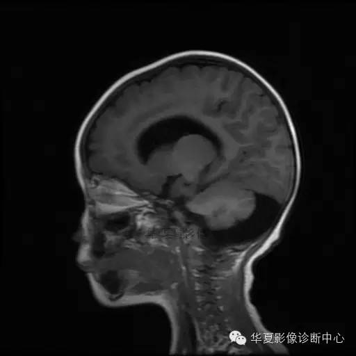 【病例学习】Dandy- Walker's畸形一例MR影像表现 【病例学习】Dandy- Walker's畸形一例MR影像表现