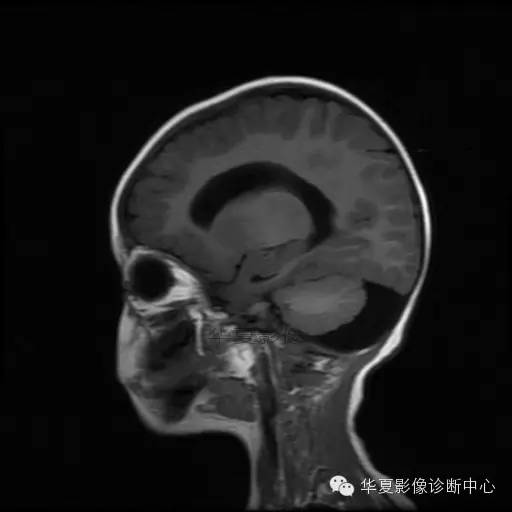 【病例学习】Dandy- Walker's畸形一例MR影像表现 【病例学习】Dandy- Walker's畸形一例MR影像表现