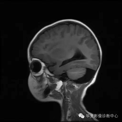【病例学习】Dandy- Walker's畸形一例MR影像表现 【病例学习】Dandy- Walker's畸形一例MR影像表现