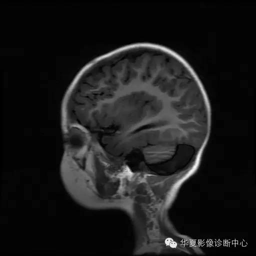 【病例学习】Dandy- Walker's畸形一例MR影像表现 【病例学习】Dandy- Walker's畸形一例MR影像表现