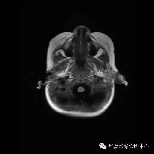【病例学习】Dandy- Walker's畸形一例MR影像表现 【病例学习】Dandy- Walker's畸形一例MR影像表现