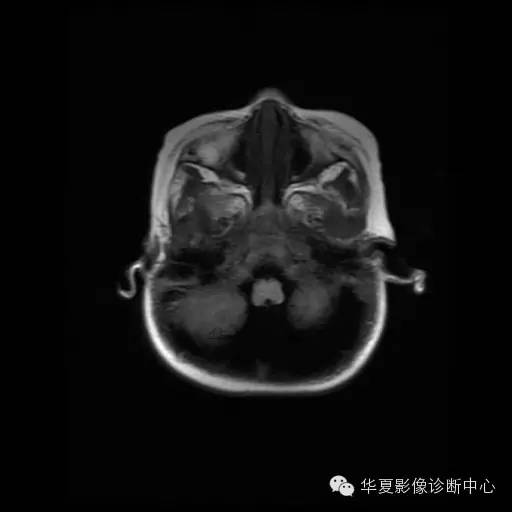 【病例学习】Dandy- Walker's畸形一例MR影像表现 【病例学习】Dandy- Walker's畸形一例MR影像表现