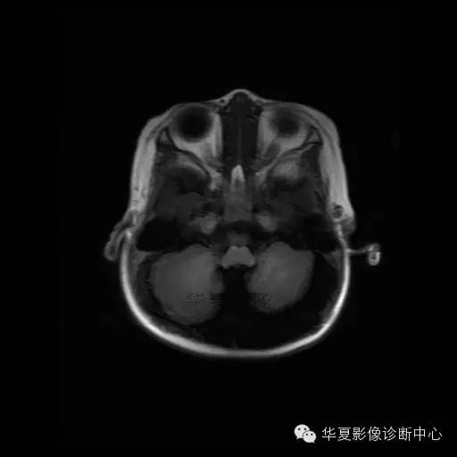 【病例学习】Dandy- Walker's畸形一例MR影像表现 【病例学习】Dandy- Walker's畸形一例MR影像表现