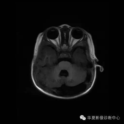 【病例学习】Dandy- Walker's畸形一例MR影像表现 【病例学习】Dandy- Walker's畸形一例MR影像表现