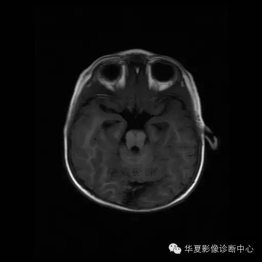 【病例学习】Dandy- Walker's畸形一例MR影像表现 【病例学习】Dandy- Walker's畸形一例MR影像表现
