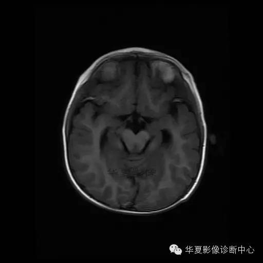 【病例学习】Dandy- Walker's畸形一例MR影像表现 【病例学习】Dandy- Walker's畸形一例MR影像表现