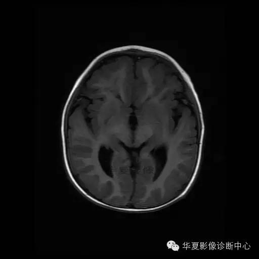 【病例学习】Dandy- Walker's畸形一例MR影像表现 【病例学习】Dandy- Walker's畸形一例MR影像表现