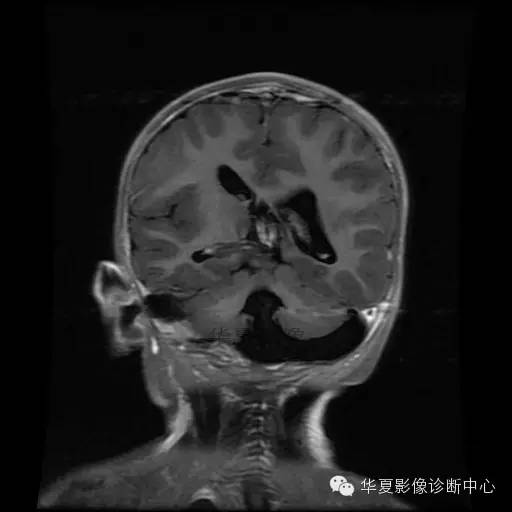 【病例学习】Dandy- Walker's畸形一例MR影像表现 【病例学习】Dandy- Walker's畸形一例MR影像表现