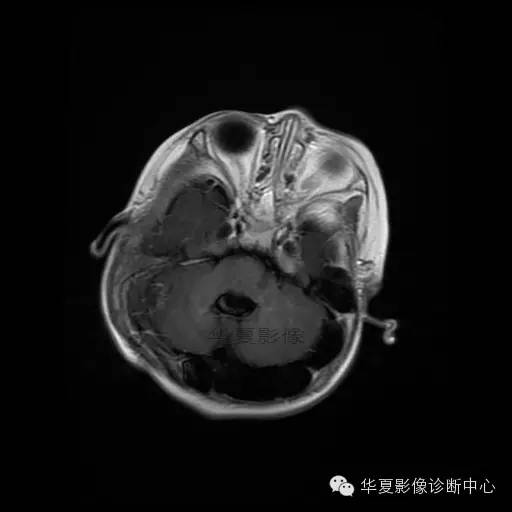 【病例学习】Dandy- Walker's畸形一例MR影像表现 【病例学习】Dandy- Walker's畸形一例MR影像表现
