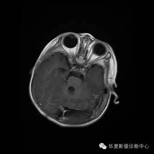 【病例学习】Dandy- Walker's畸形一例MR影像表现 【病例学习】Dandy- Walker's畸形一例MR影像表现