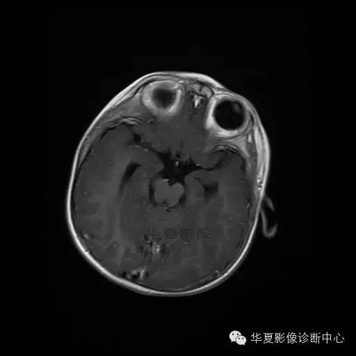 【病例学习】Dandy- Walker's畸形一例MR影像表现 【病例学习】Dandy- Walker's畸形一例MR影像表现