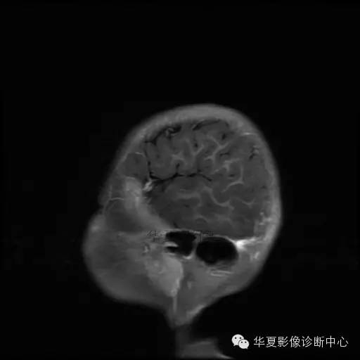 【病例学习】Dandy- Walker's畸形一例MR影像表现 【病例学习】Dandy- Walker's畸形一例MR影像表现