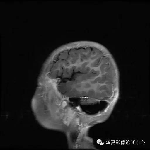 【病例学习】Dandy- Walker's畸形一例MR影像表现 【病例学习】Dandy- Walker's畸形一例MR影像表现