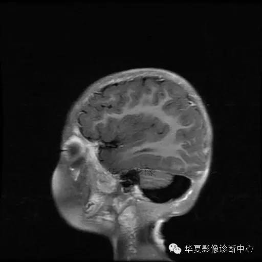 【病例学习】Dandy- Walker's畸形一例MR影像表现 【病例学习】Dandy- Walker's畸形一例MR影像表现