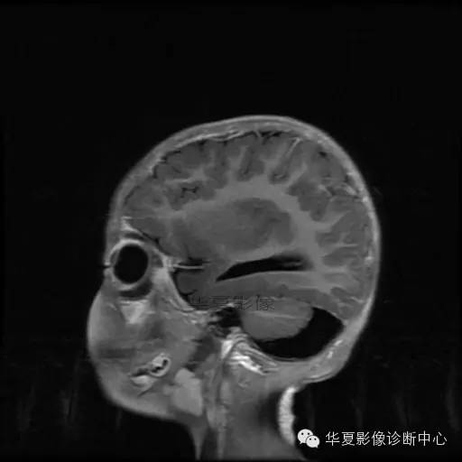 【病例学习】Dandy- Walker's畸形一例MR影像表现 【病例学习】Dandy- Walker's畸形一例MR影像表现