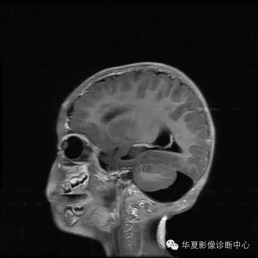 【病例学习】Dandy- Walker's畸形一例MR影像表现 【病例学习】Dandy- Walker's畸形一例MR影像表现