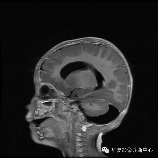 【病例学习】Dandy- Walker's畸形一例MR影像表现 【病例学习】Dandy- Walker's畸形一例MR影像表现