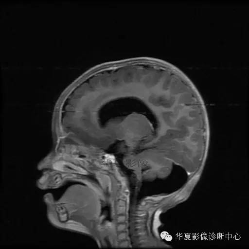 【病例学习】Dandy- Walker's畸形一例MR影像表现 【病例学习】Dandy- Walker's畸形一例MR影像表现
