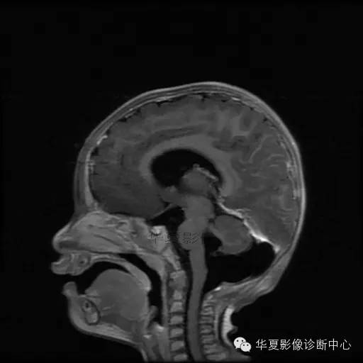 【病例学习】Dandy- Walker's畸形一例MR影像表现 【病例学习】Dandy- Walker's畸形一例MR影像表现