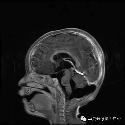 【病例学习】Dandy- Walker's畸形一例MR影像表现 【病例学习】Dandy- Walker's畸形一例MR影像表现
