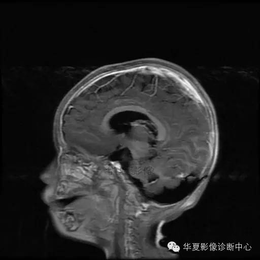 【病例学习】Dandy- Walker's畸形一例MR影像表现 【病例学习】Dandy- Walker's畸形一例MR影像表现