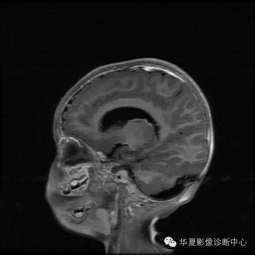 【病例学习】Dandy- Walker's畸形一例MR影像表现 【病例学习】Dandy- Walker's畸形一例MR影像表现