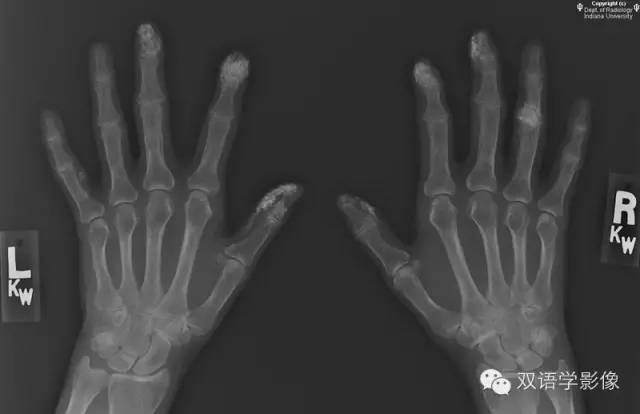 【双语病例】系统性硬化症（硬皮病）一例X线影像表现