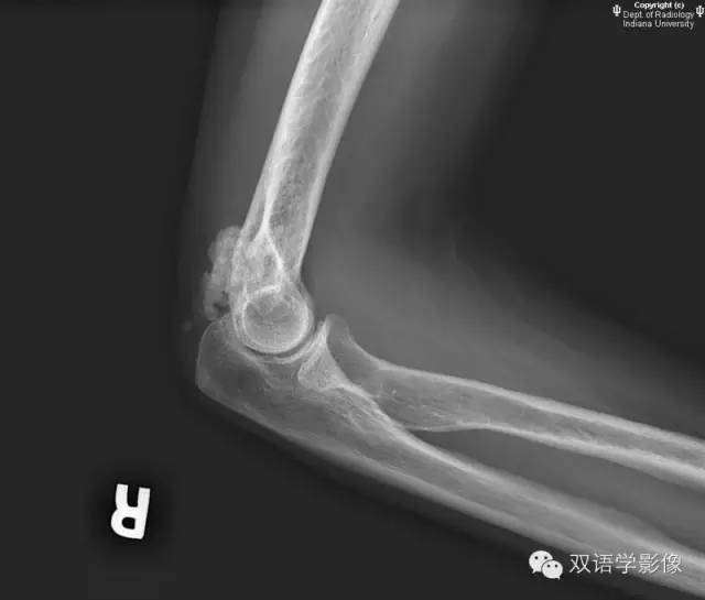 【双语病例】系统性硬化症（硬皮病）一例X线影像表现