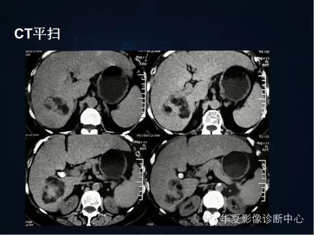 【病例学习】原发性肝癌伴脂肪变性一例影像表现